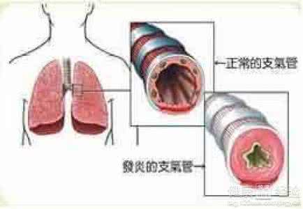支气管炎哮喘吃什么药 支气管炎哮喘 支气管炎哮喘吃什么