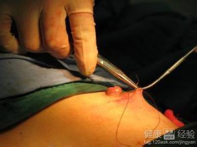 乳头内陷最严重图 乳头内陷是怎么回事