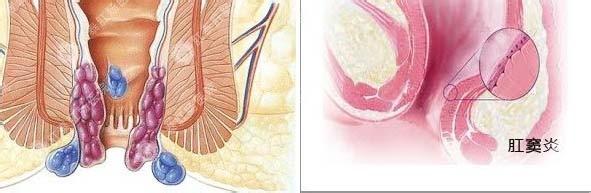 肛窦炎的症状和治疗 什么是肛窦炎 肛窦炎的症状与治疗