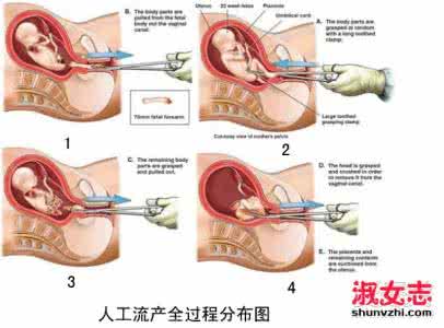 人流后多久会再次怀孕 人流后多长时间可以再怀孕