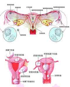 异位妊娠保守治疗 异位妊娠 如何治疗异位妊娠