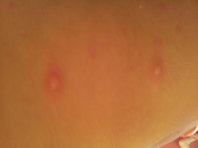 出水痘如何治疗 水痘如何治疗 出水痘该如何治疗