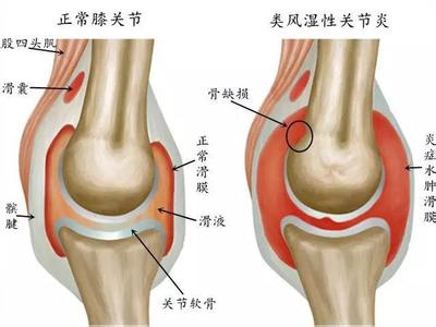 踝关节骨性关节炎 踝关节骨性关节炎的两个主要症状