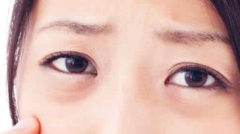 去除眼袋手术费用 眼袋去除术 眼袋祛除术