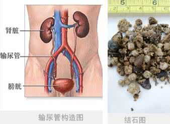 泌尿系统结石的预防 泌尿系统结石 泌尿系统结石的饮食预防