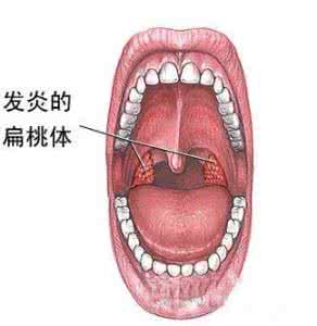 治扁桃体炎最有效的药 一个很有效的方子(扁桃体炎)