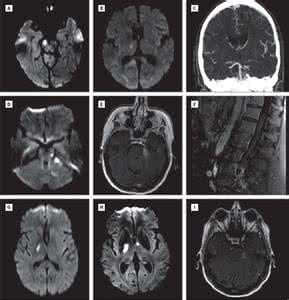 jama neurology jama neurology JAMA Neurology 脑扫描的“疼痛感”是真的吗