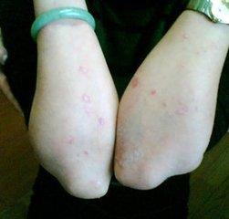 湿疹吃什么药好的最快 湿疹多吃什么