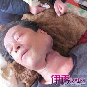 淋巴癌晚期的症状 淋巴癌晚期 淋巴癌晚期的症状与治疗