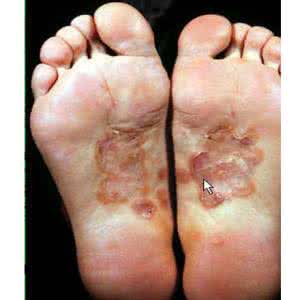 二期梅毒的主要症状 男性梅毒二期症状 二期梅毒有什么症状