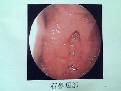 舌根运动法治咽喉炎 每天动舌根可以治咽炎 