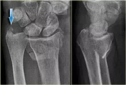 腕关节病变影像学诊断 小孩腕关节影像图 【急诊】腕关节及手平片--临床影像示例