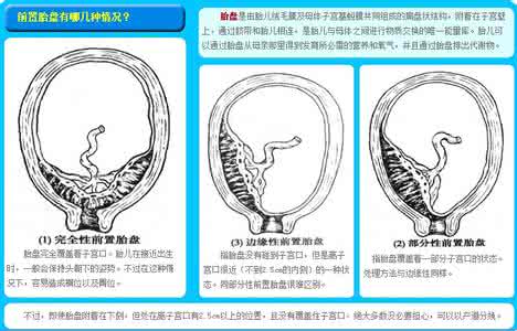 中央性前置胎盘不可怕 中央性前置胎盘