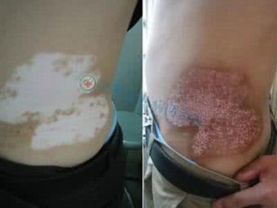 感冒引起鼻炎吃什么药 什么药能引起白癜风?