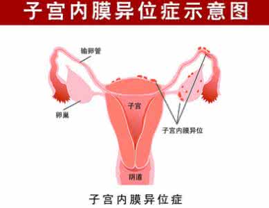 子宫内膜异位症的危害 子宫内膜异位症的危害 子宫内膜异位症危害是什么