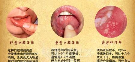 口腔溃疡点一下就好了 口腔溃疡点一下就好了 口腔溃疡不要怕，用好这三味中药就好啦！