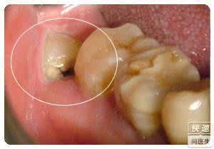 智齿冠周炎症状 急性智齿冠周炎 智齿冠周炎很痛苦 主要有哪些症状表现？