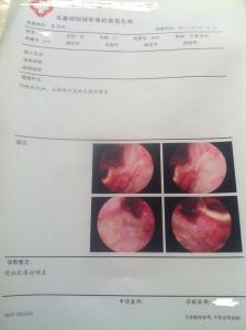 慢性咽炎是什么感觉 【五官保健】慢性咽炎的诊断标准是什么