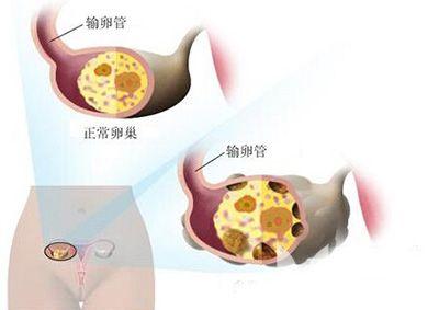 多囊卵巢综合征怀孕 多囊卵巢综合征患者为何很难怀孕？