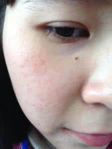 春季皮肤过敏痒怎么办 春季皮肤为什么会痒 春季为什么皮肤会过敏