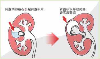 肾结石会导致肾积水吗 肾积水会导致脚肿吗？