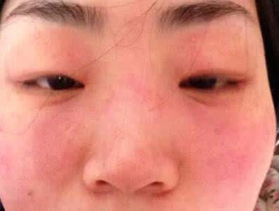 皮肤过敏该怎么办 皮肤过敏该怎么办 儿童皮肤过敏该怎么办