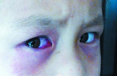 结膜炎会传染吗 结膜炎 结膜炎公司会要吗？