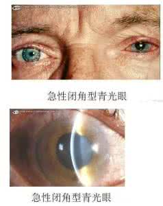 导致青光眼的原因 导致青光眼的原因 青光眼的治疗方法 什么原因导致了青光眼