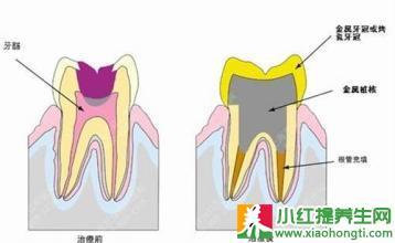 牙髓炎根管治疗步骤 牙髓炎症状 如何治疗牙髓炎