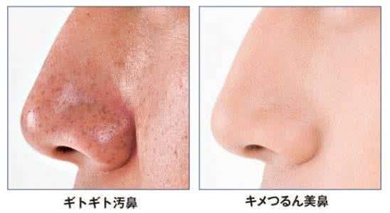 毛孔粗大有黑头怎么办 夹黑头会使毛孔粗大吗？