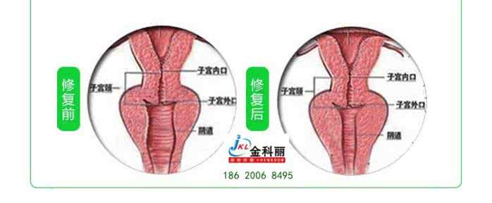 女性缩阴影音先锋 女性缩阴护理的方法有哪些