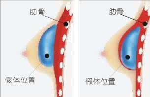 糖尿病能引发房颤吗 因胸部撞击而引发房颤