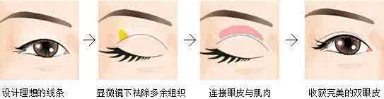 做了双眼皮埋线消肿 埋线双眼皮消肿 埋线双眼皮消肿怎么做