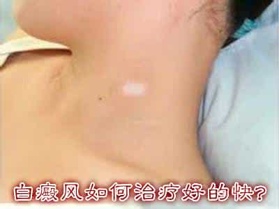 如何治疗痔疮效果好 如何治疗白癜风 这样治疗效果好