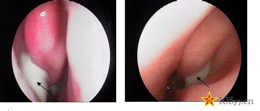 慢性鼻窦炎秘方集 慢性鼻窦炎秘方