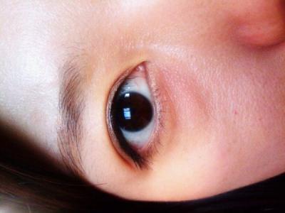 金霉素眼膏去除脂肪粒 金霉素眼膏去除脂肪粒 金霉素能去除脂肪粒吗？