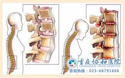 怎么治疗强制性脊柱炎 强制性脊柱炎 教你如何正确治疗脊柱炎