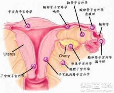 宫外孕是什么症状 宫外孕有哪些症状 宫外孕是什么？有哪些症状？
