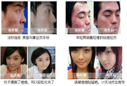 如何彻底去痤疮 怎么祛痤疮 什么方法