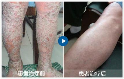 牛皮癬是什么引起的 牛皮癣是如何形成的