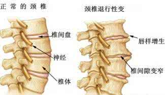 预防骨质增生的方法 预防骨质增生的食谱大全