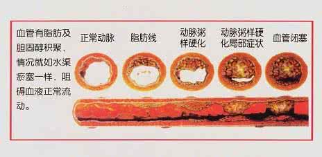 下肢动脉硬化和冠心病 动脉硬化冠心病1