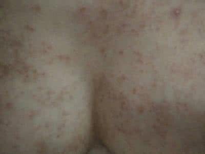 过敏留下黑印会消退吗 过敏留下黑印会消退吗？