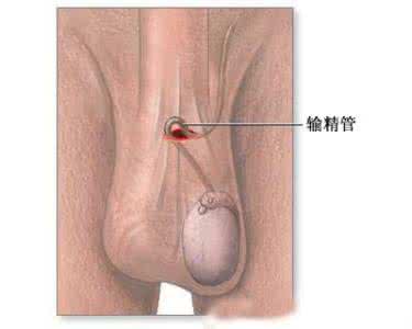 输精管结扎术 输精管结扎后不会变“太监”：输精管结扎术不会破坏睾丸分泌雄性激素