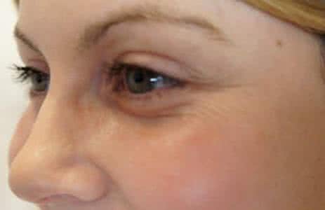 怎样防止鱼尾纹 怎样防止皱纹产生 如何防止鱼尾纹