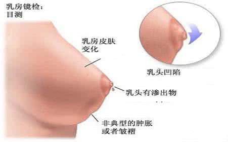 乳腺增生和乳腺纤维瘤 乳腺纤维瘤和乳腺增生会癌变吗