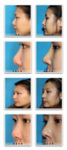 假体隆鼻后效果自然吗 假体隆鼻后效果自然吗 做假体隆鼻的效果自然吗