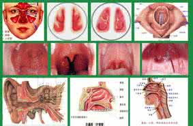 吃错了东西意料治好了多年的慢性咽炎 怎么一直没想到这土方法