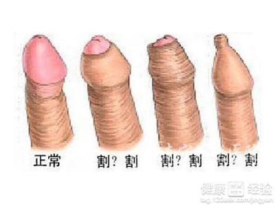 激光治疗包茎多少钱 怎样治包皮过长好呢？