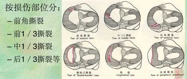 半月板二度损伤严重吗 半月板三度损伤严重吗 这几样家用电器放在财位上严重损财
